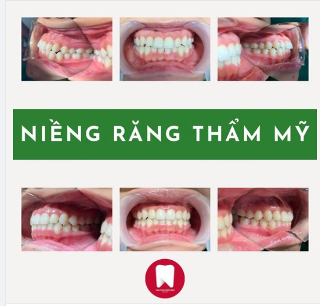 Niềng răng có thể đem tới những điều tích cực nào?