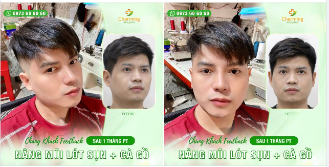 Hình ảnh của chàng khách đây là minh chứng cho thấy combo nâng mũi lót sụn kết hợp cà gồ không chỉ phù hợp với nữ giới.