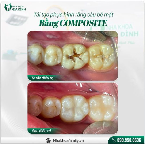 GIẢI PHÁP NÀO CHO RĂNG HÀM BỊ SÂU BỀ MẶT