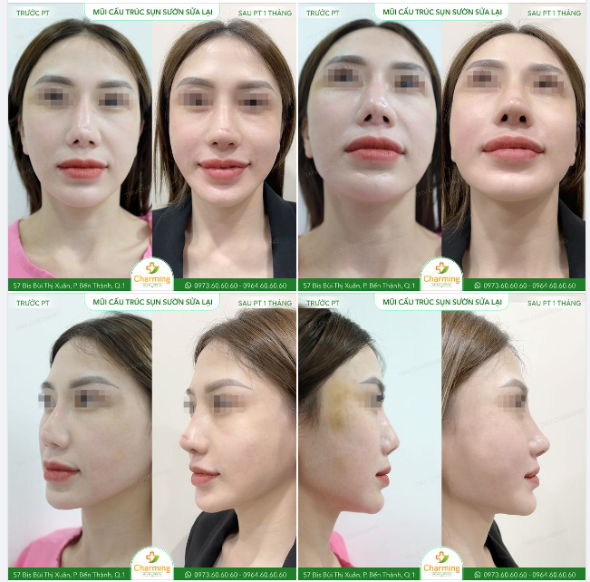 Nụ cười nhẹ trên môi nàng khách ở bức hình "Sau phẫu thuật 1 tháng"" đã chứng tỏ nàng rất ưng ý với kết quả của phẫu thuật nâng mũi sửa lại.