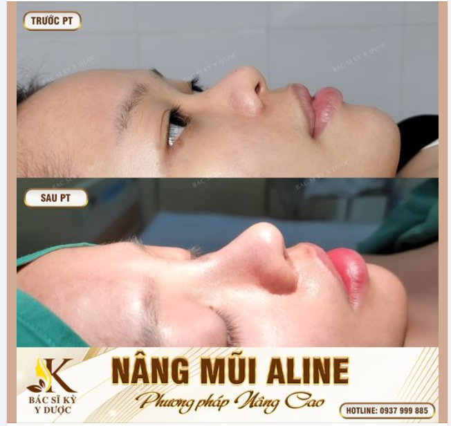NẾU BẠN ĐÃ CHÁN NGẤY DÁNG MŨI THẤP TẸT, HÃY THỬ 1 LẦN ĐẾN GẶP BÁC SĨ KỲ Y DƯỢC