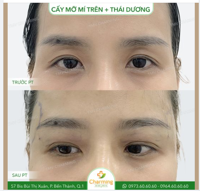 Quá trình cấy mỡ diễn ra rất nhanh chóng nhưng lại giữ được hiệu quả rất lâu dài, nên nàng khách và mọi người có thể an tâm tỏa sáng đó nha