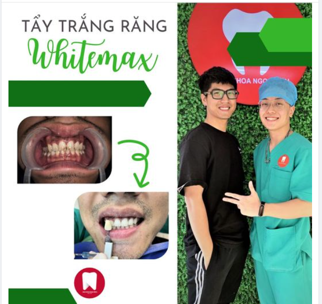 RĂNG XỈN MÀU Ố VÀNG VÀ CÁCH KHẮC PHỤC NHANH CHÓNG, KHÔNG HẠI MEN RĂNG