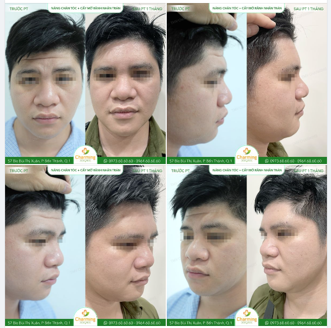 Mọi người chắc đã quen với nâng mũi, nâng cung mày rồi nhưng chắc hẳn sẽ còn thấy hơi lạ với phương pháp nâng chân tóc đúng không nào?