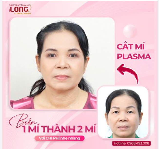BIẾN MẮT “1 MÍ” THÀNH “2 MÍ” VỚI CHI PHÍ NHẸ NHÀNG ÁP DỤNG CÔNG NGHỆ CẮT MÍ PLASMA