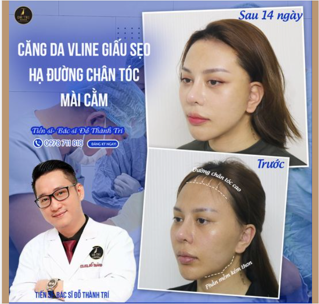 XU HƯỚNG THẨM MỸ MỚI! BIẾN MẶT DÀI THÀNH MẶT BABY-FACE VLINE!