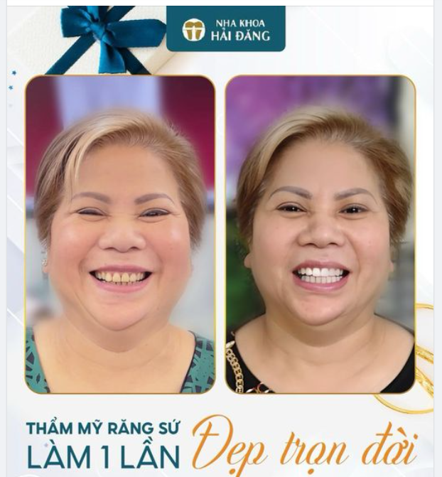 THẨM MỸ RĂNG SỨ LÀM MỘT LẦN ĐẸP TRỌN ĐỜI
