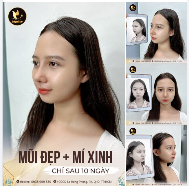COMBO NÂNG MŨI CẤU TRÚC + CẮT MẮT 2 MÍ BÍ QUYẾT TỎA SÁNG CỦA CÔ NÀNG GENZ TUYẾT NHƯ