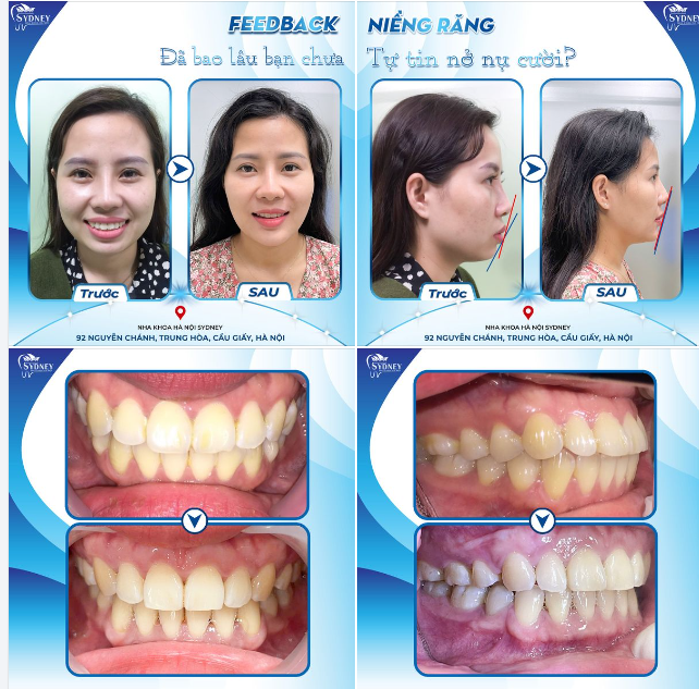 ĐÃ BAO LÂU BẠN CHƯA TỰ TIN NỞ NỤ CƯỜI?