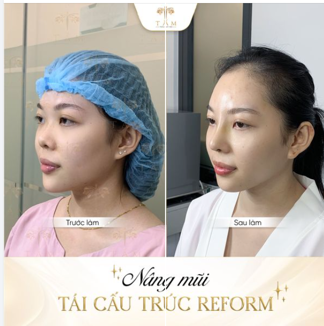 Tại sao phải tự ti với chiếc mũi thấp khi bạn có thể đến Tấm thay đổi nó ngay lập tức?