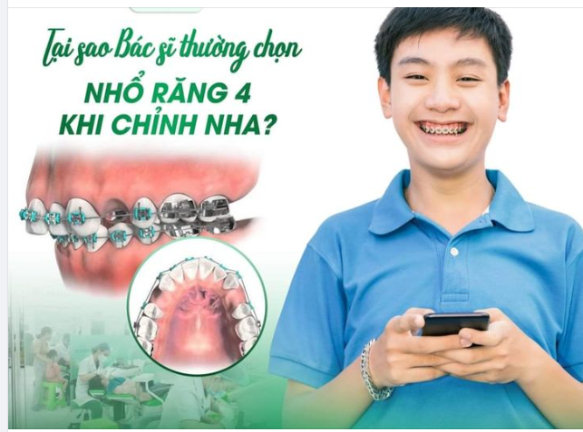 VÌ SAO BÁC SĨ THƯỜNG CHỌN NHỔ RĂNG SỐ 4 KHI NIỀNG?