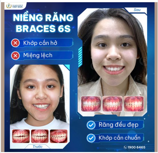 NIỀNG RĂNG HẾT LỆCH MIỆNG, HẾT LỆCH MẶT KHÔNG CẦN PHẪU THUẬT