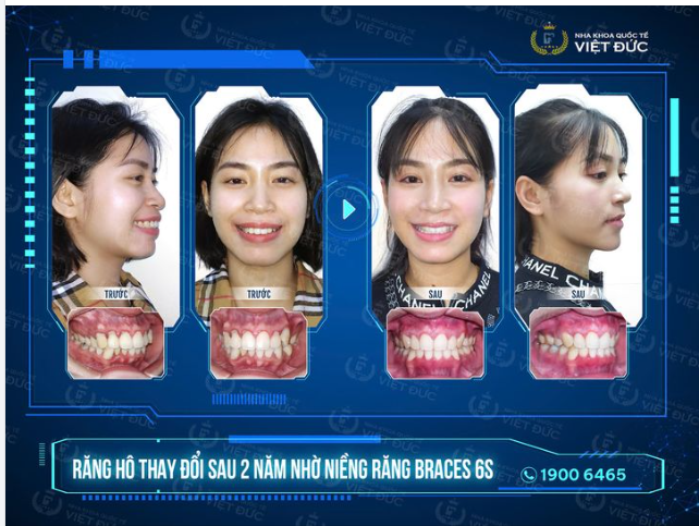 NIỀNG RĂNG - SỞ HỮU GÓC NGHIÊNG HOÀN HẢO