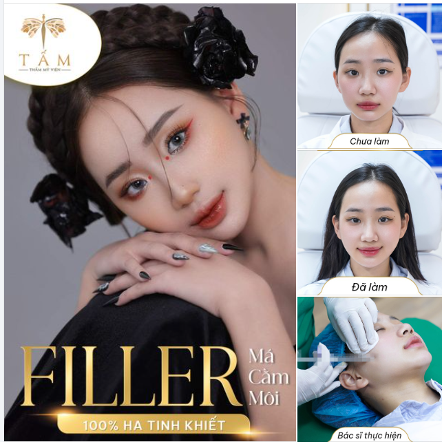 ĐÂY LÀ MÌNH LÚC CHƯA VÀ ĐÃ LÀM FILLER TẠI TẤM
