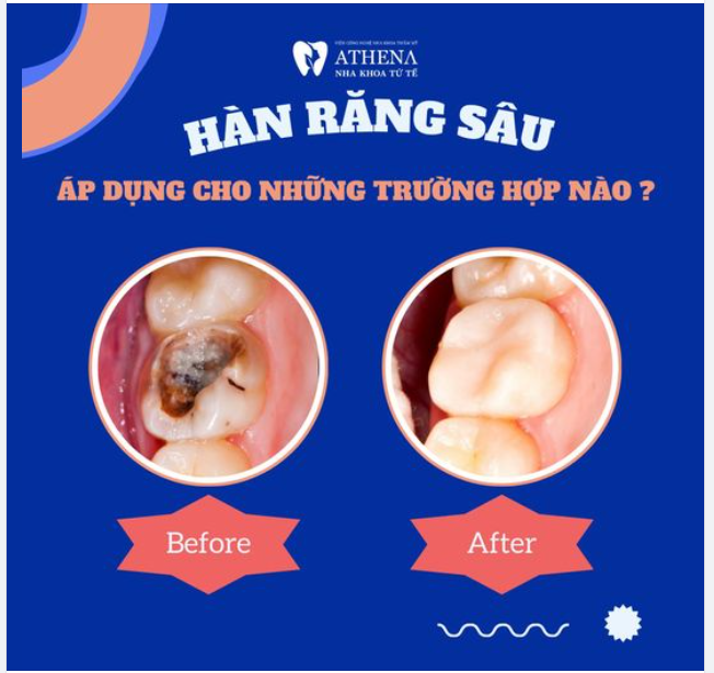 Khi nào cần thực hiện hàn răng sâu?
