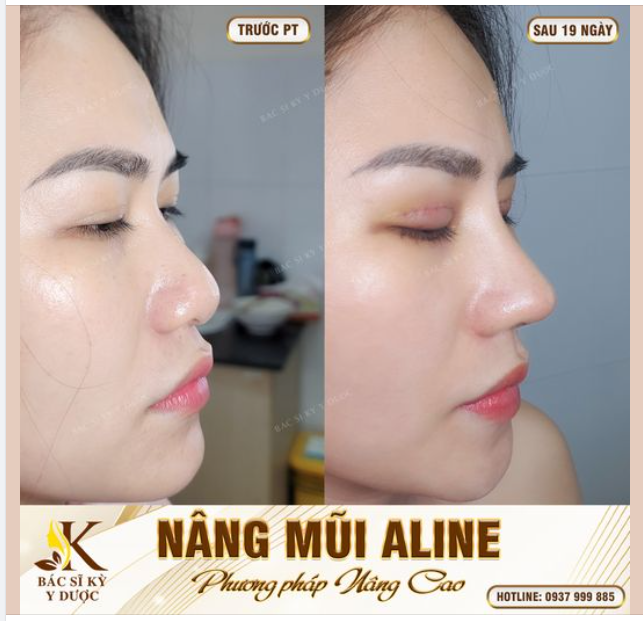 NÂNG MŨI BAO LÂU THÌ ĐẸP?