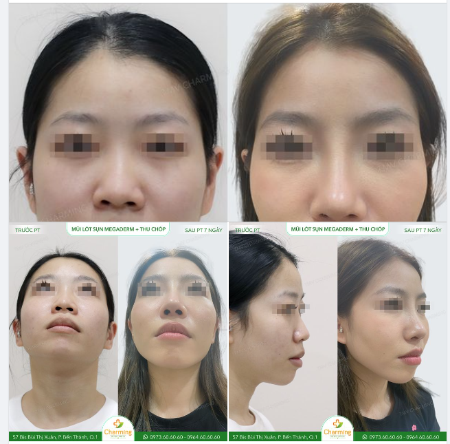 Dù bác sĩ Khanh có thực hiện nâng mũi bằng megaderm, nhưng bác ấy rất thận trọng với phương pháp này vì không phải ai cũng phù hợp.