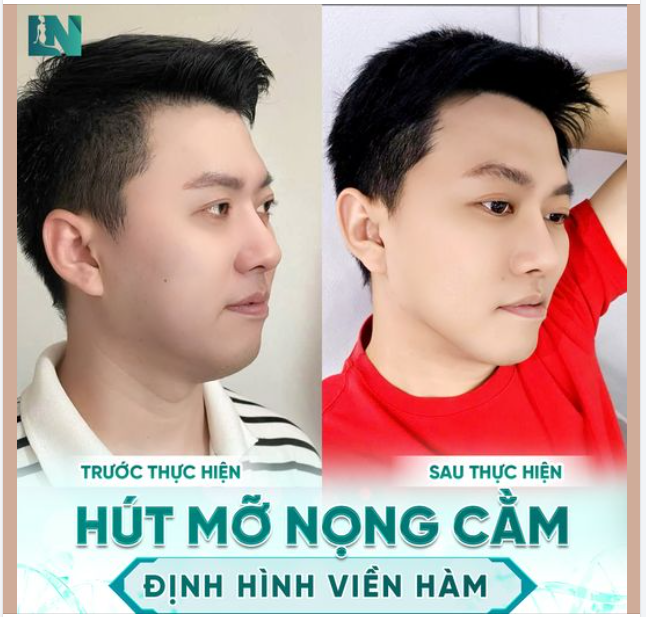 Tình trạng nọng cằm xuất hiện do mỡ thừa tích tụ nhiều ở vùng cằm, khiến cho khuôn mặt của bạn chảy xệ kém duyên, già nua và mất cân đối.