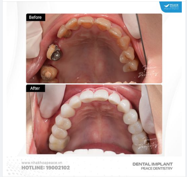 CA LÂM SÀNG IMPLANT KẾT HỢP THẨM MỸ RĂNG SỨ TOÀN DIỆN