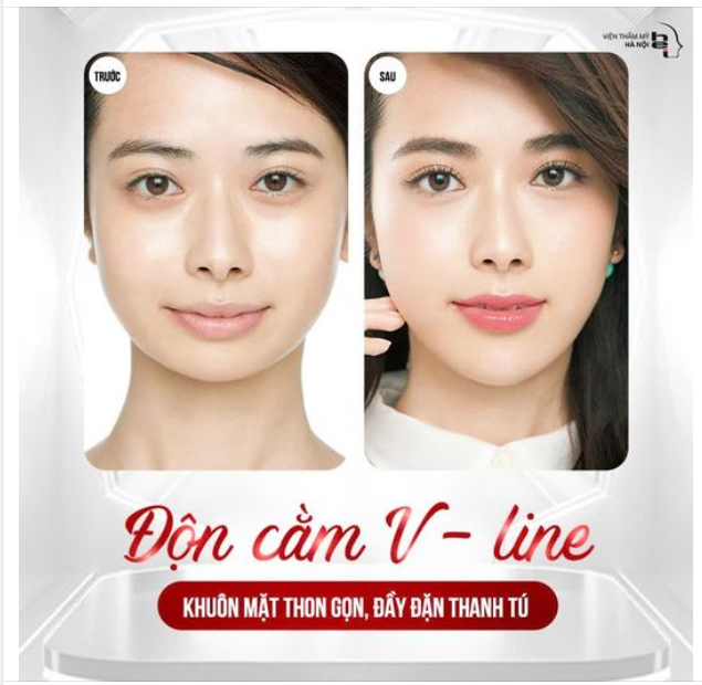 Độn cằm V-line là gì