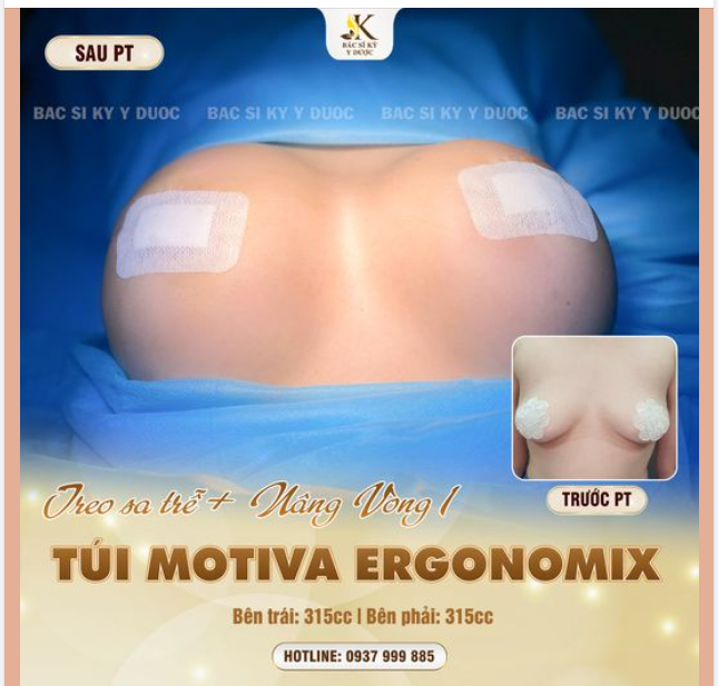 CẢI THIỆN VÒNG 1 CHẢY XỆ CHỈ SAU 1 LẦN THỰC HIỆN