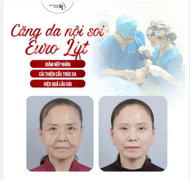 CĂNG DA NỘI SOI EURO LIFT- TRẺ HOÁ XOÁ NHĂN