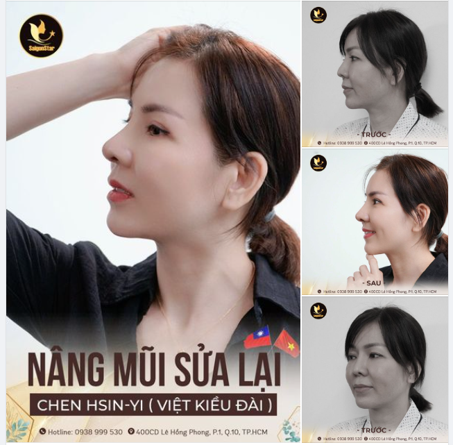 VỀ VIỆT NAM SỬA LẠI MŨI HỎNG - CHỊ KHÁCH ĐÀI LOAN NHẬN LẠI CÁI KẾT NHƯ Ý