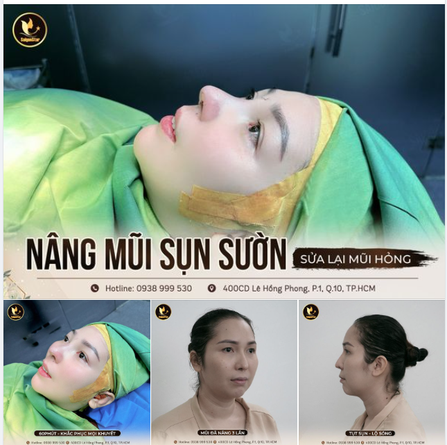 NÂNG MŨI SỤN SƯỜN - SỬA LẠI MŨI HỎNG KH. HỒNG DÂN