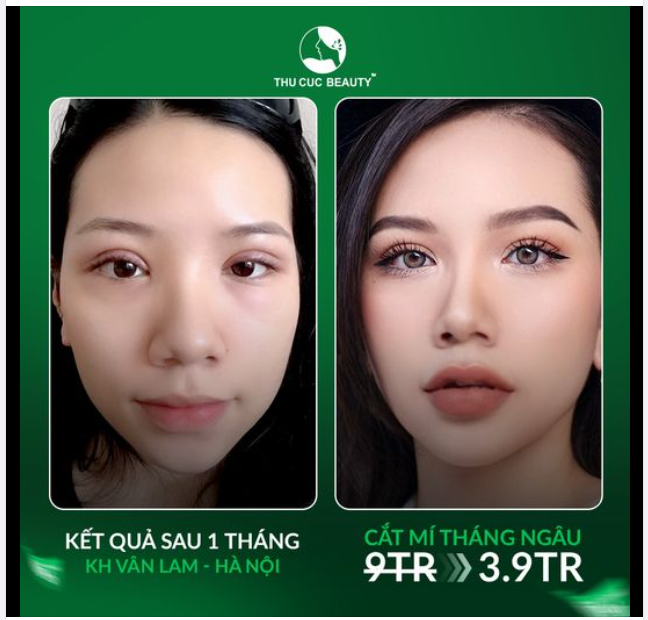 Tin tưởng cắt mí tại Thu Cúc và đây là kết quả sau 1 tháng của KH Vân Lam