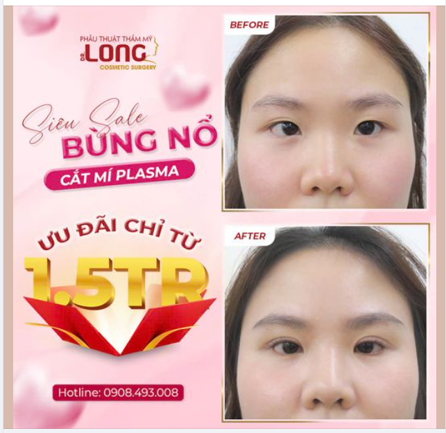 SALE BÙNG NỔ CẮT MÍ PLASMA ƯU ĐÃI LÊN ĐẾN 1.500.000 TRIỆU ĐỒNG