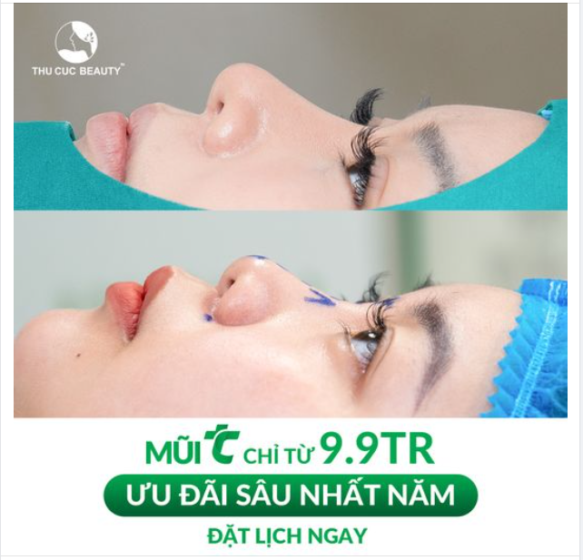 Thay đổi dáng mũi. Thần thái rạng ngời  Mũi TC sale "đỉnh nóc" chỉ từ 9.9Tr