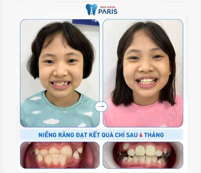 Phương pháp: Tiền chỉnh nha với mắc cài, tranfore nong ngang, chỉnh cắn ngược và khấp khểnh