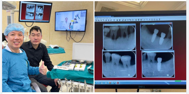 TRỒNG RĂNG IMPLANT - PHỤC HÌNH RĂNG MẤT