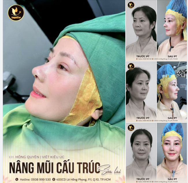 NÂNG MŨI CẤU TRÚC GIẢI PHÁP KHẮC PHỤC MŨI HỎNG AN TOÀN - HIỆU QUẢ
