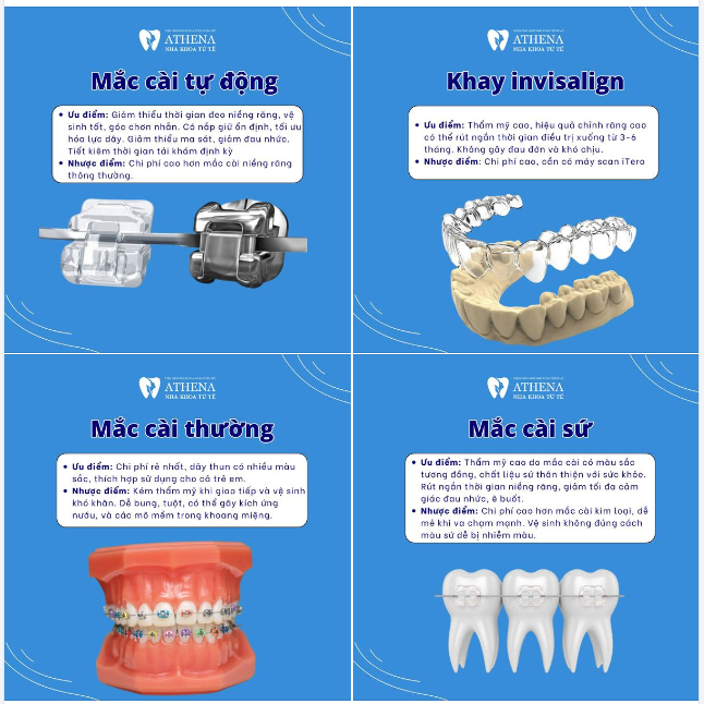 Gợi ý phương pháp niềng răng phù hợp với bạn