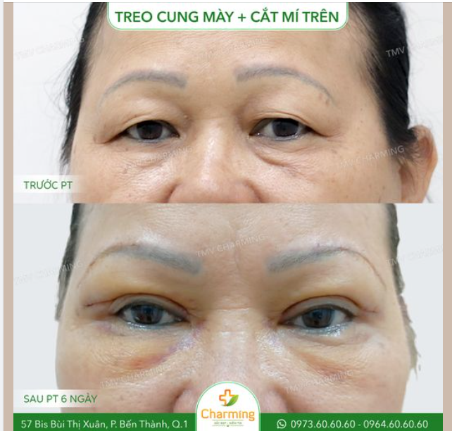 Sau khi thực hiện phẫu thuật, đôi mắt của cô khách tuy còn hơi sưng nhưng có thể thấy rõ là đã có thần sắc hơn, tươi tắn và trẻ trung hơn nhiều đó nha