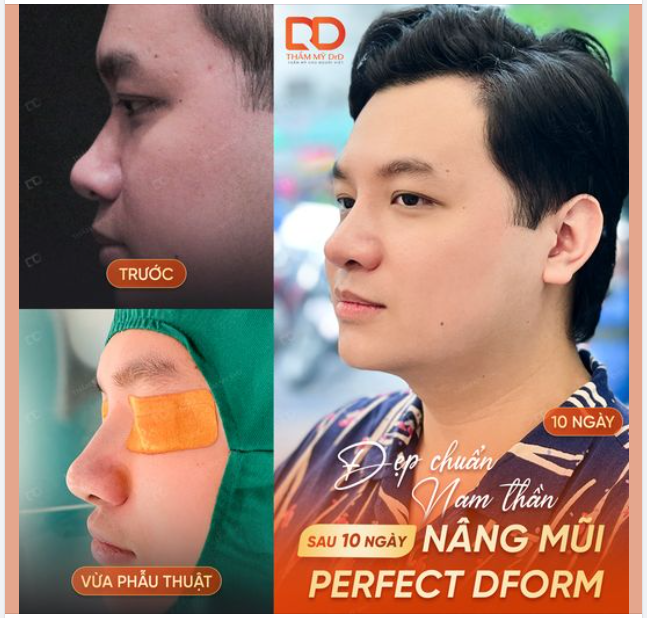 ĐẸP CHUẨN NAM THẦN sau 10 ngày Nâng mũi Perfect Dform