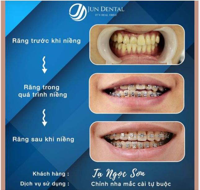 NGÀY ĐƯỢC CÁC ĐỒNG NIỀNG MONG CHỜ NHẤT LÀ NGÀY ĐƯỢC THÁO NIỀNG