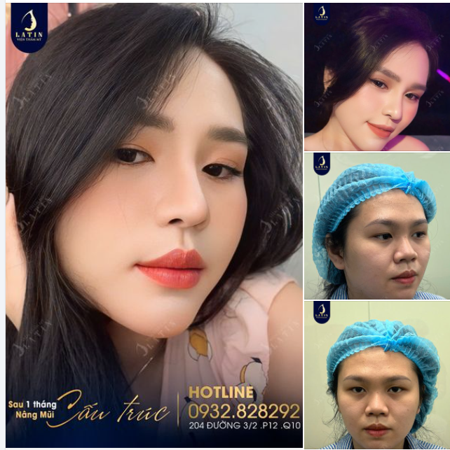 Sau 1 tháng nâng mũi, em thay đổi như thế nào