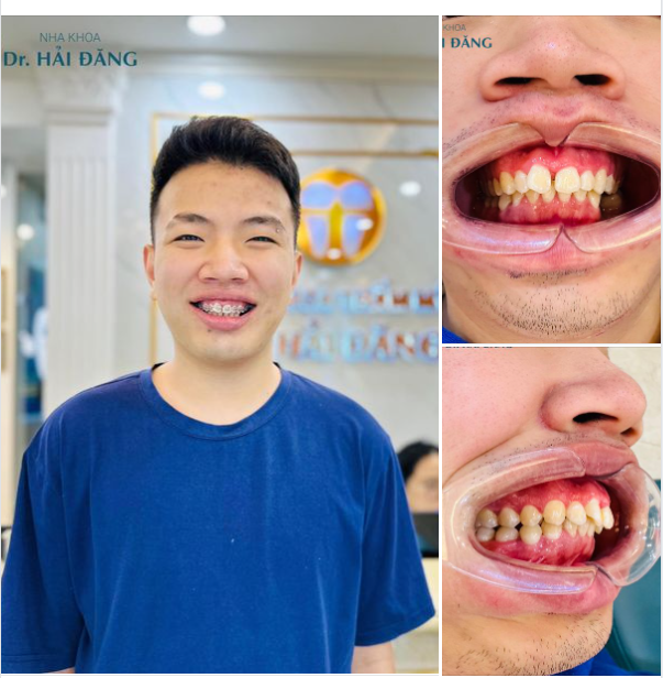 CHÚC MỪNG KHÁCH HÀNG NGÀY ĐẦU GẮN MẮC CÀI
