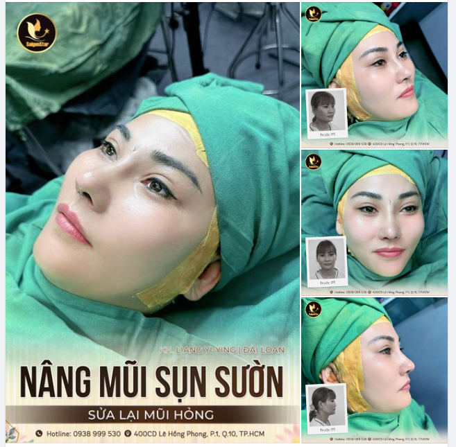 SỬA LẠI MŨI HỎNG - CUỘC ĐỜI SANG TRANG