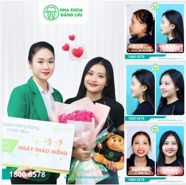 RĂNG XINH RỒI, THÁO NIỀNG THÔI!