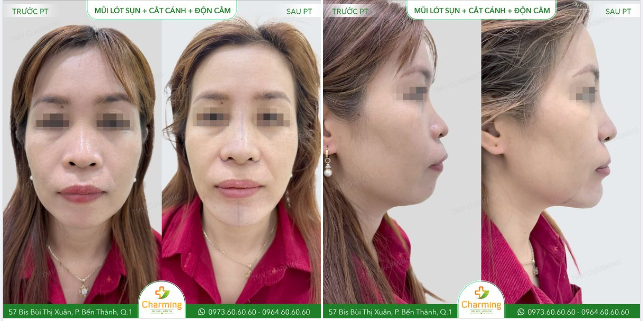 Nhìn vào hình ảnh trước và sau khi nâng mũi lót sụn, cắt cánh mũi và độn cằm của nàng khách đây, Charming phải thốt lên câu: "Quá đã!" khi nhìn thấy sự thay đổi tích cực trên gương mặt của nàng.