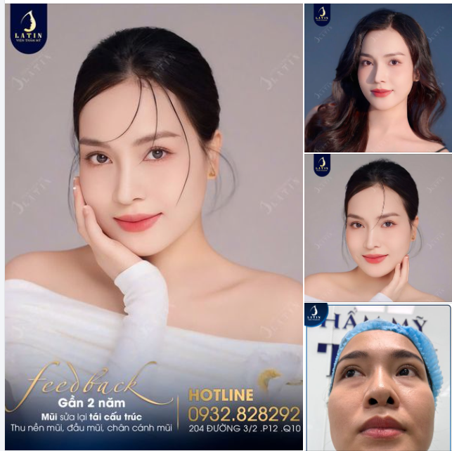 Chị khách Đà Nẵng tự tin, xinh đẹp sau 2 năm sửa mũi tại Latin