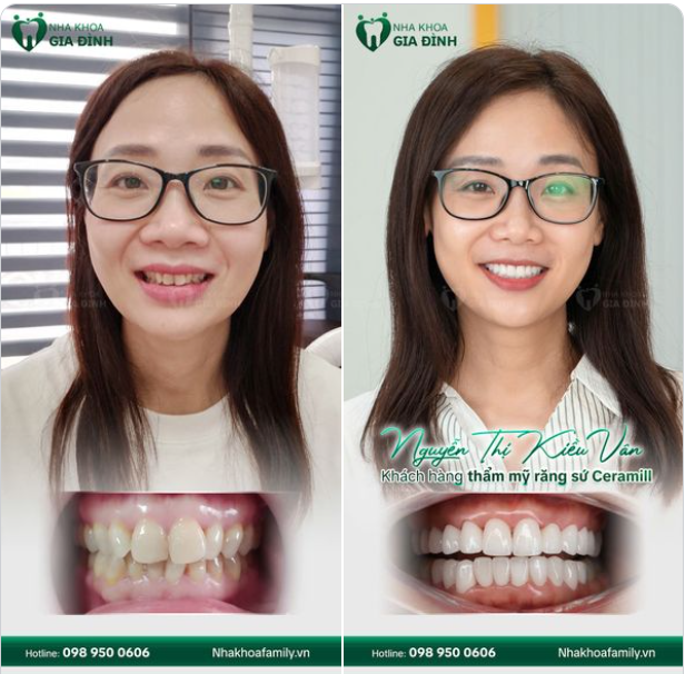 MONG MUỐN MỘT HÀM RĂNG ĐỀU ĐẸP TỪ RẤT LÂU RỒI, NAY ĐÃ THÀNH SỰ THẬT