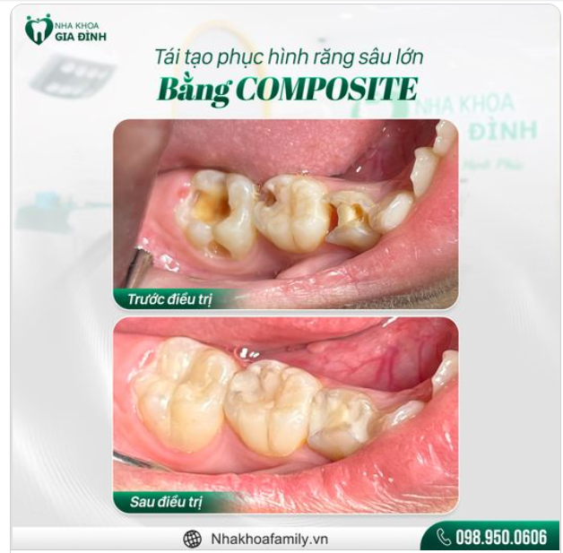 PHỤC HÌNH RĂNG SÂU VỠ LỚN VỚI TIÊU CHÍ BẢO TỒN RĂNG THẬT TỐI ĐA