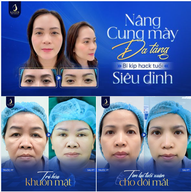 Bí kip hack tuổi - Nâng cung mày đa tầng