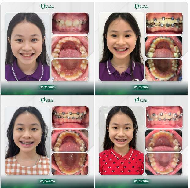 CHA MẸ BẤT NGỜ VỚI SỰ THAY ĐỔI CỦA CON GÁI CHỈ SAU VÀI THÁNG CHỈNH NHA