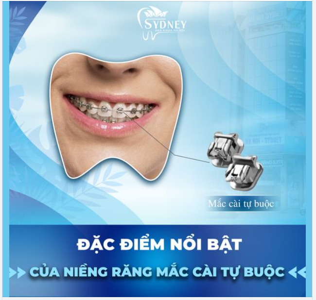 ĐẶC ĐIỂM NỔI BẬT CỦA NIỀNG RĂNG MẮC CÀI TỰ BUỘC