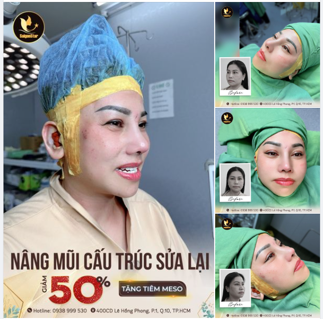 60 PHÚT NÂNG MŨI CẤU TRÚC - THÀNH CÔNG GIÚP CHỊ LIANG YI YIN ĐẾN TỪ ĐÀI LOAN CẢI THIỆN MŨI HỎNG!!